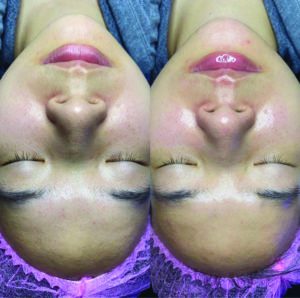 Hydrafacial by Dermatology Affliates