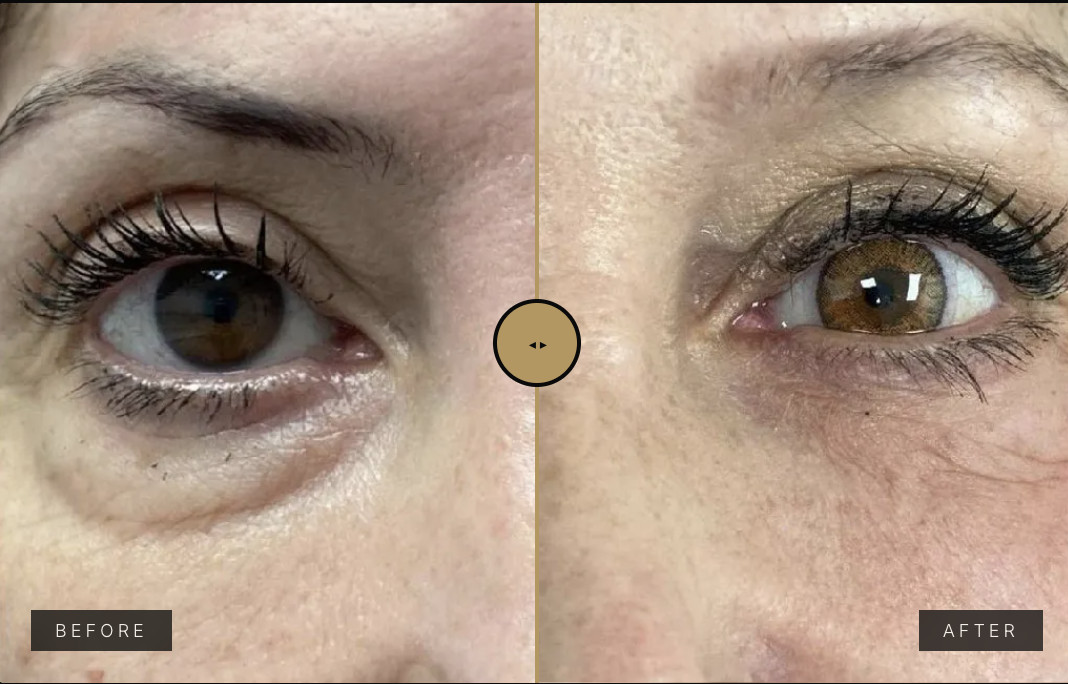 An Endolift Before & After