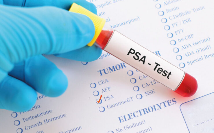 PSA Screening