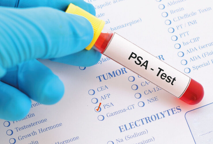 PSA Screening
