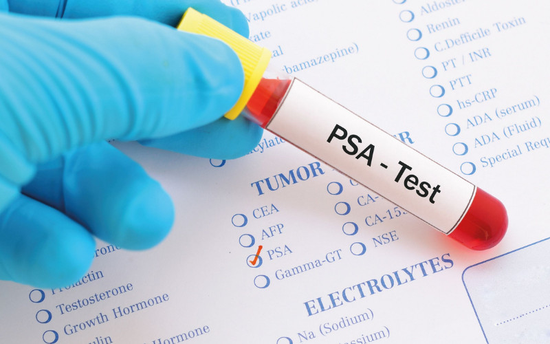 PSA Screening